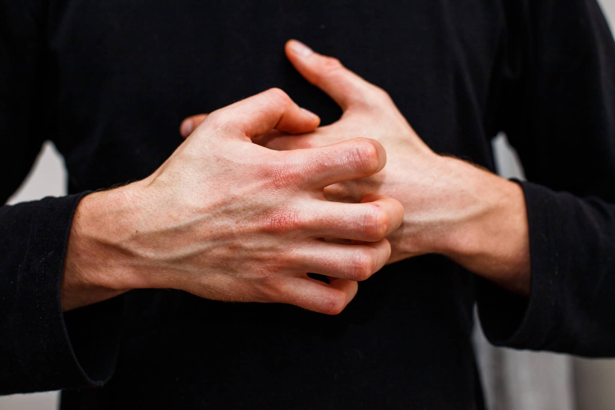 Best Treatments For Ichthyosis Vulgaris (9 Products + Tips) Mr Bees